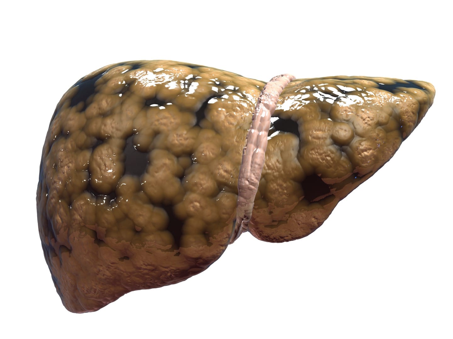 Fatty liver. The new epidemic