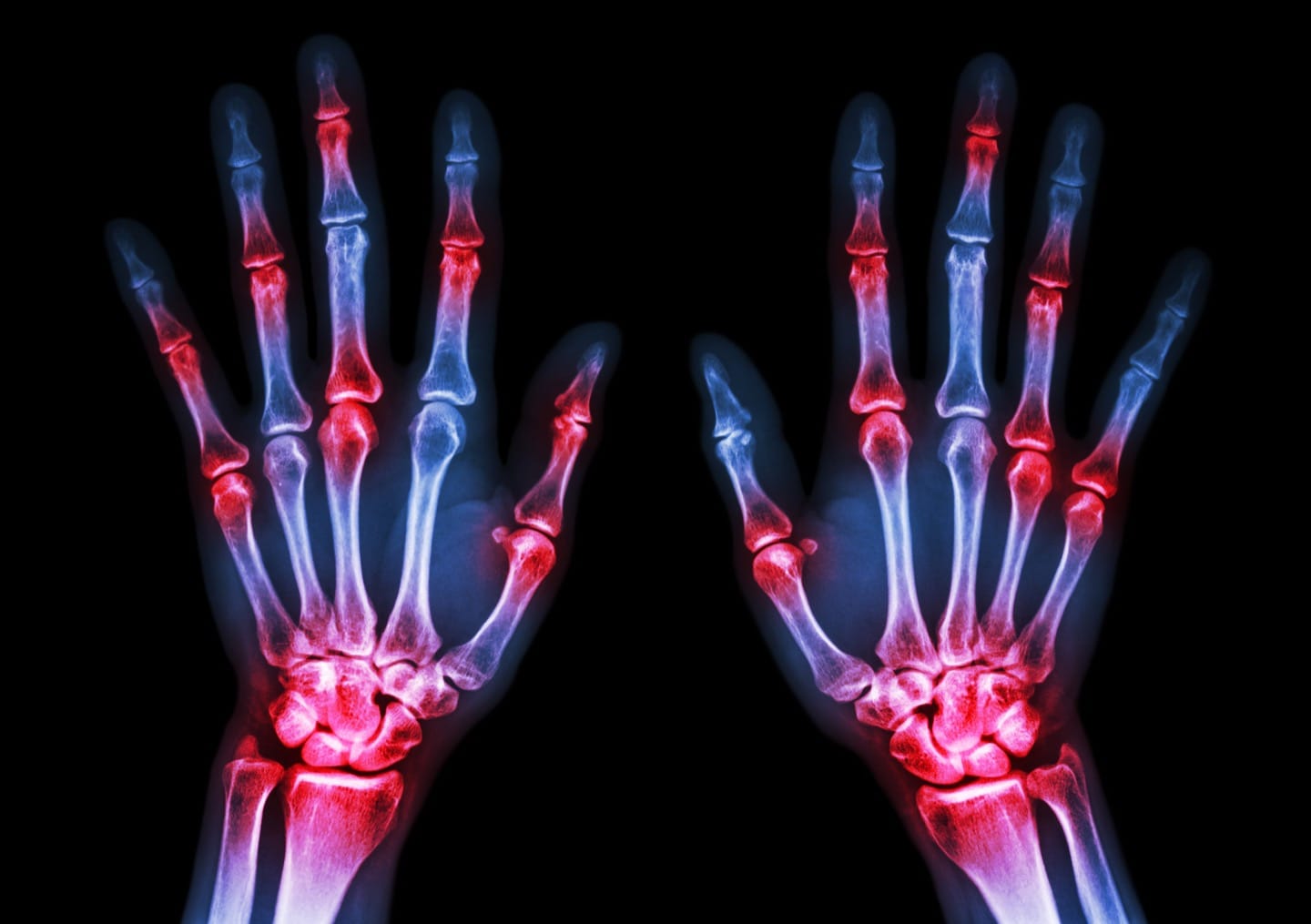 Mythbusters – Arthritis
