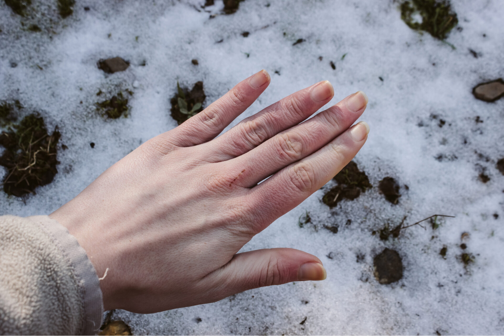 Chilblains: symptoms, causes and how to reduce your risk